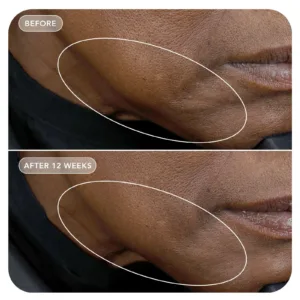 VOL.U.LIFT before and after, neck