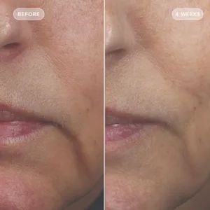 VOL.U.LIFT before and after, lower face