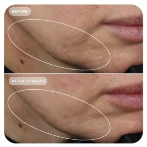 VOL.U.LIFT before and after, cheek