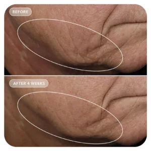 VOL.U.LIFT before and after, neck