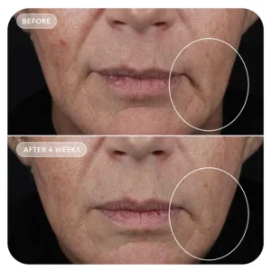 VOL.U.LIFT before and after, face